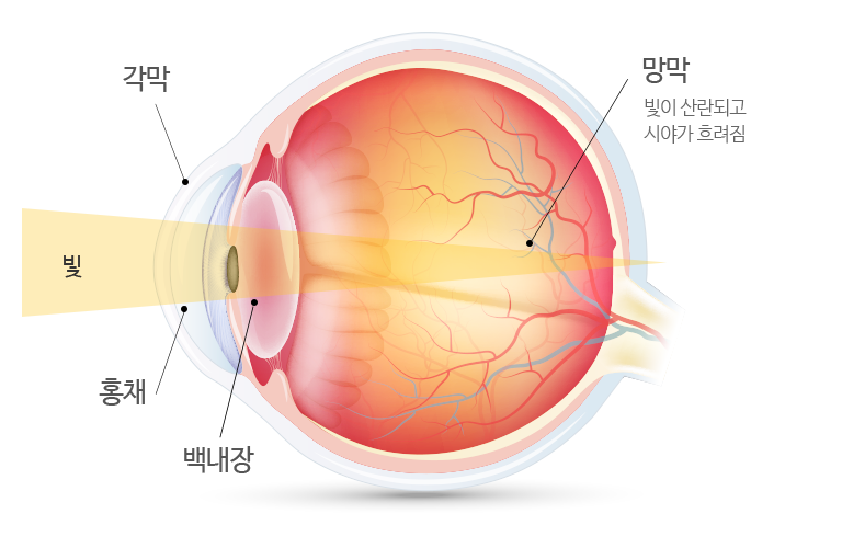 백내장안