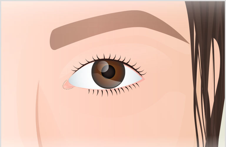 봉합