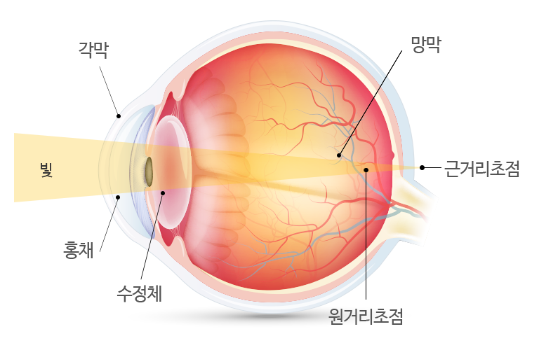 노안